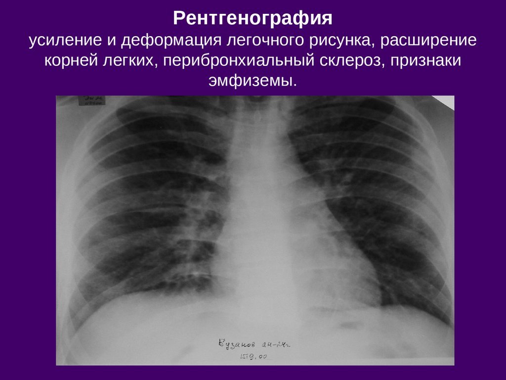 Поражение легких по типу матового