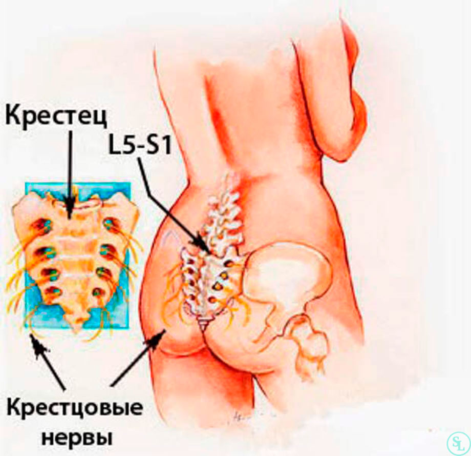 Грыжа диска