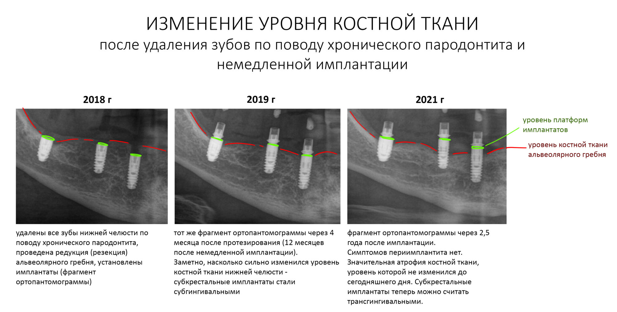 Полная потеря зубов, имплантация, протезирование: проблемы и