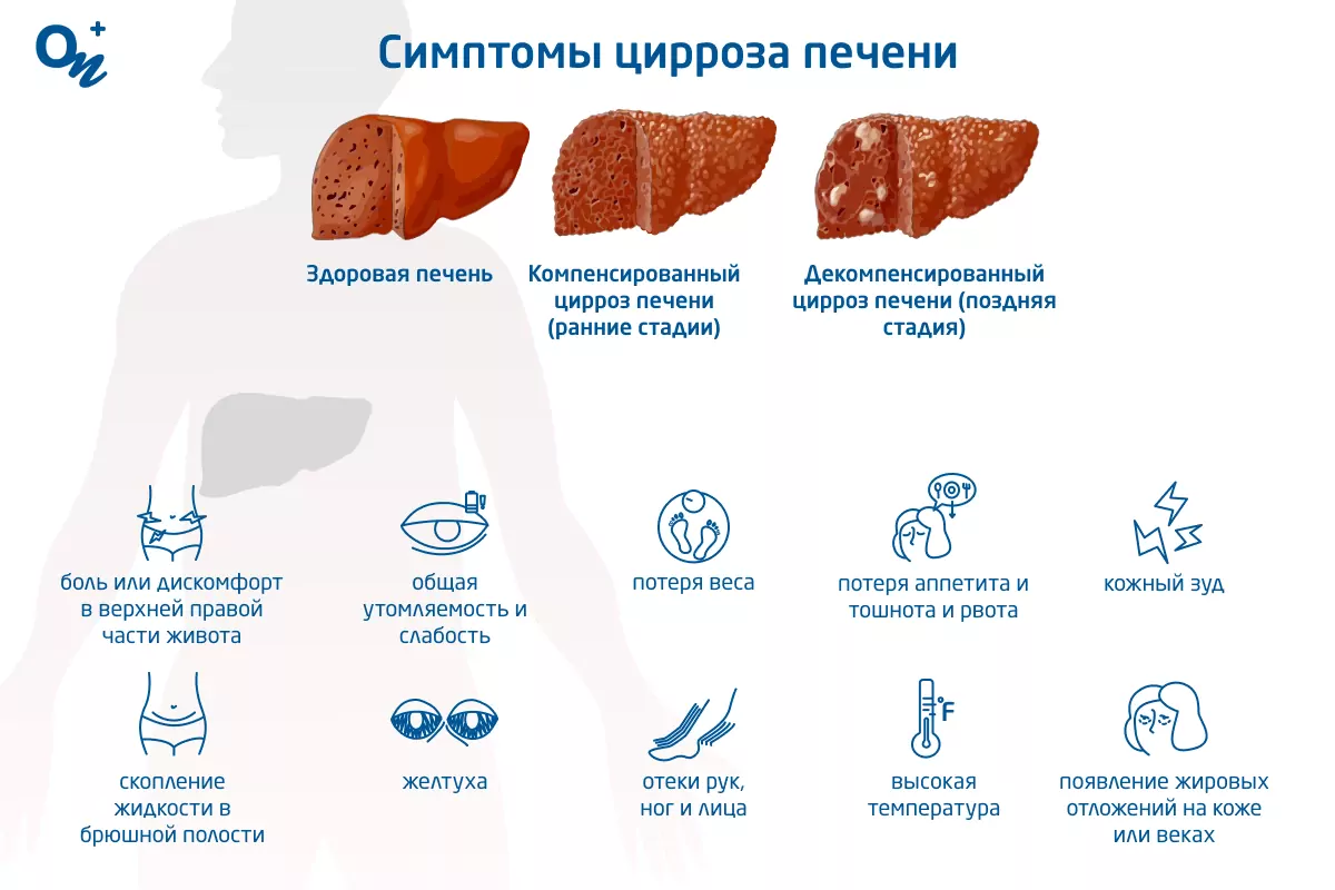 Псориаз: симптомы и лечение, причины