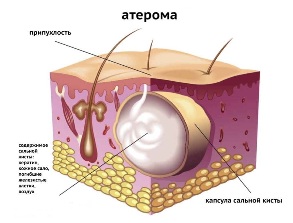 Атерома: причины, симптомы, лечение кисты сальной железы