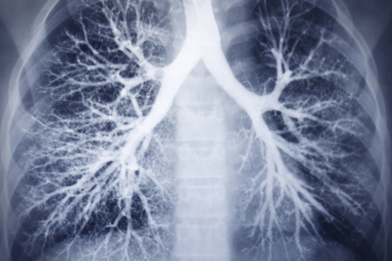 IDIOPATIC PULMONARY FIBROSIS