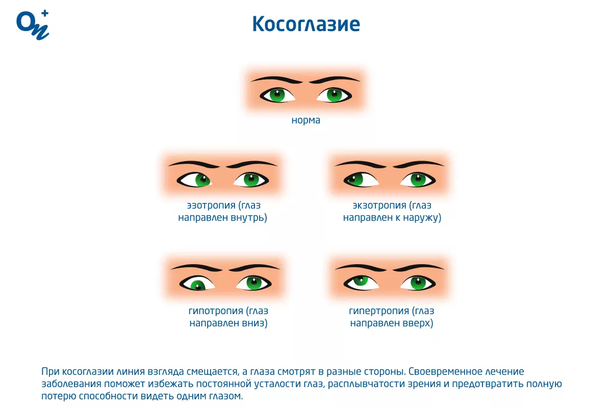 Смешные картинки Косоглазие