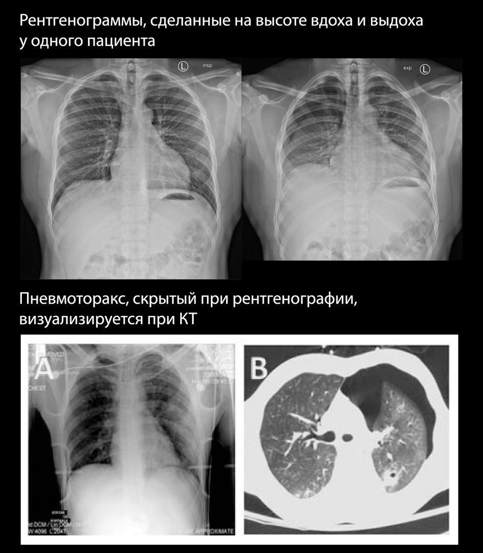 Легочные поля и зоны