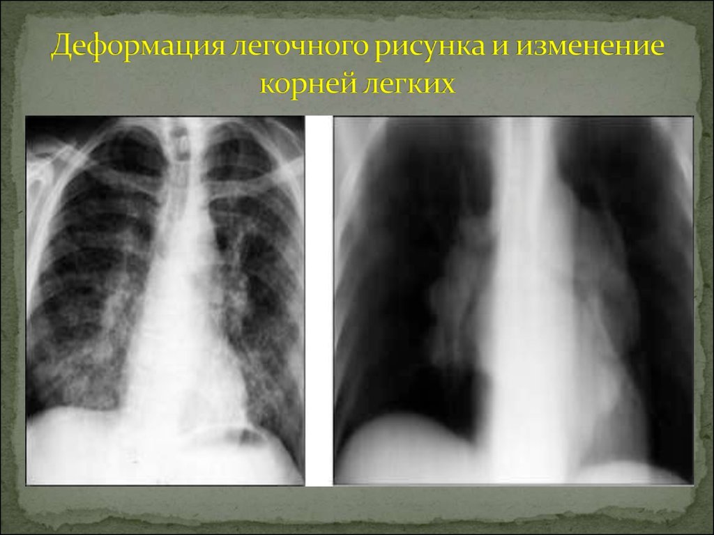 Рак легких: симптомы и признаки