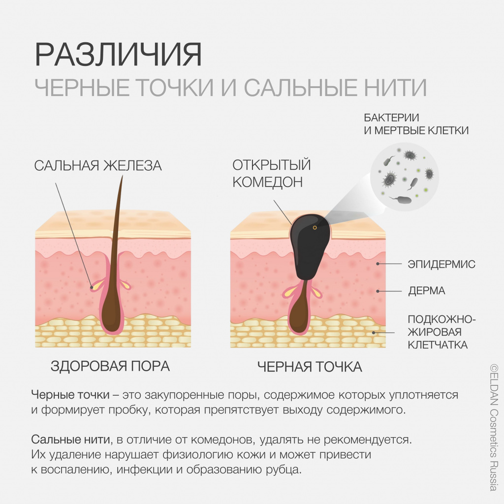 Синдром сухого глаза