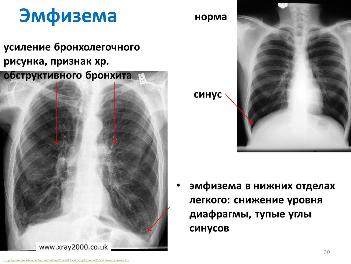 Расшифровка рентген легких