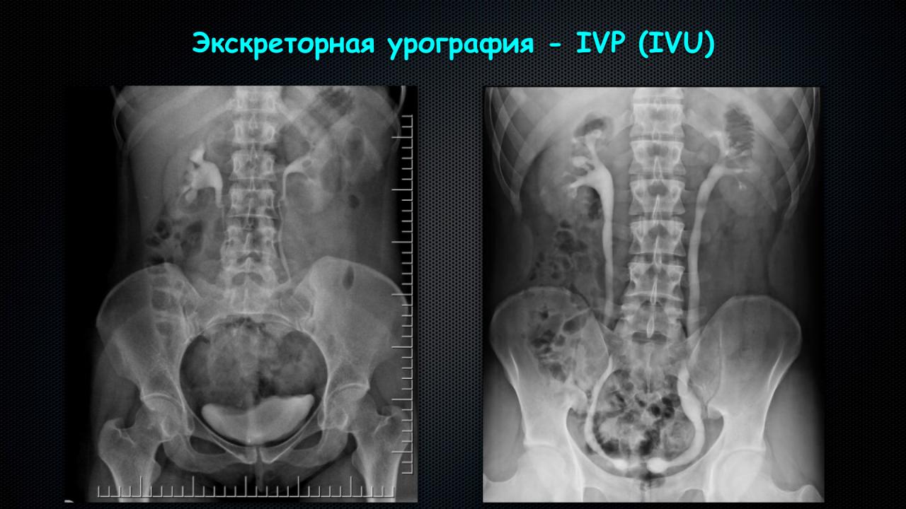 Пенильный и уретральный болевой синдром | 