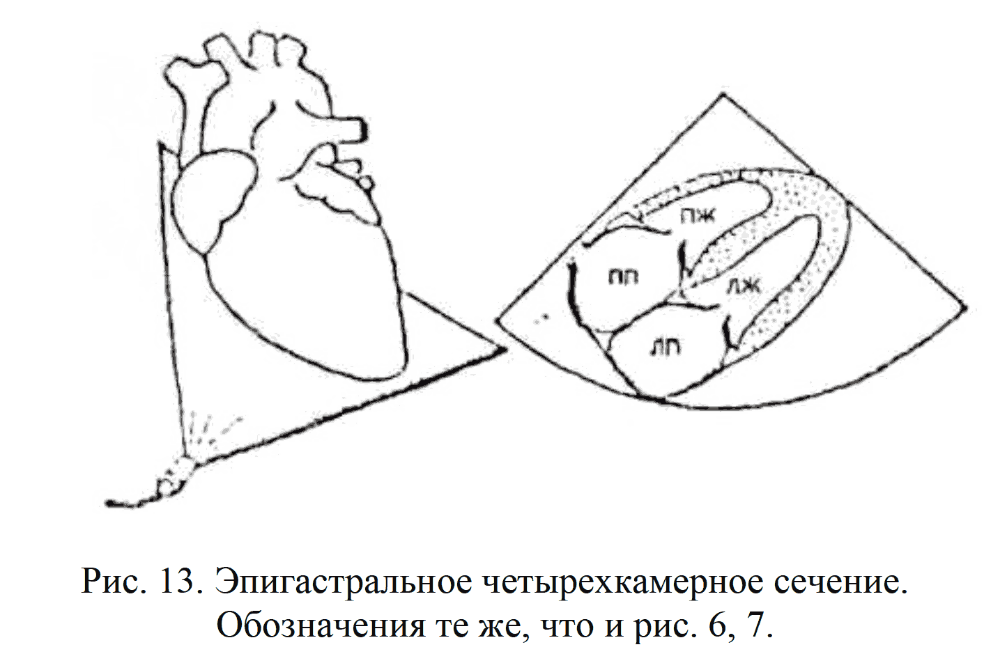 Способ рентгенодиагностики острого